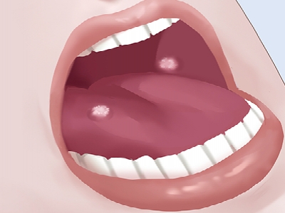口腔癌早期有什么征兆 口腔癌的发病原因有哪些